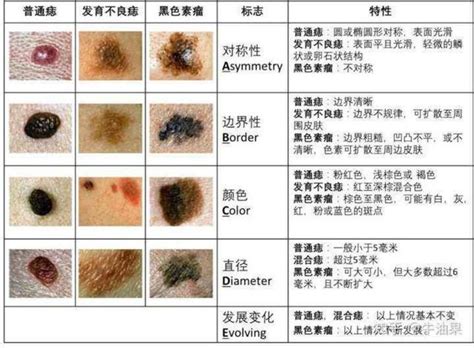 痣流血處理|痣是什麼？會變成黑色素瘤？7種一定要除的痣